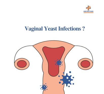 Vaginal Yeast Infections: Common Culprits for Indian Women
